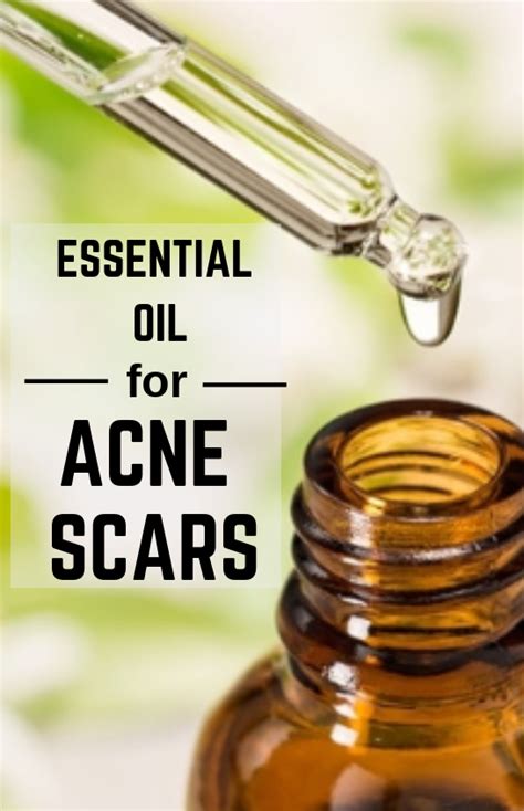 Pin On Scar Essential Oils