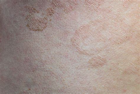 Close Up Skin Disease Tinea Versicolorpityriasis Versicolor Stock