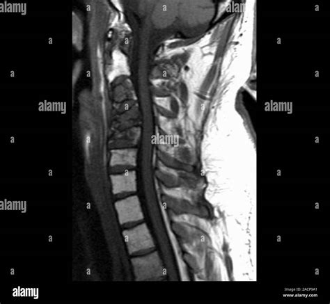 Spinal Cancer Magnetic Resonance Imaging MRI Scan Of A Sagittal