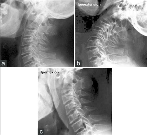 Preoperative Dynamic Cervical Spine X Ray Showing No Instability Of The