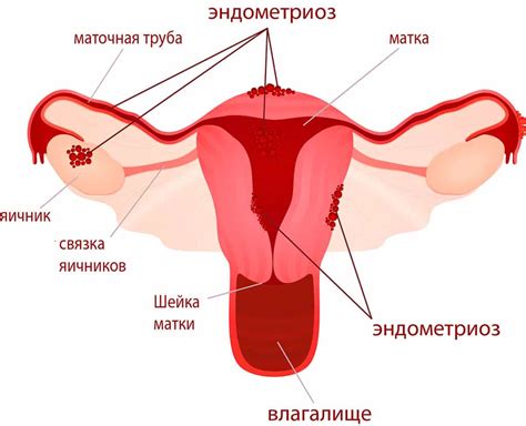Эндометриоз матки шейки тела симптомы и лечение фото