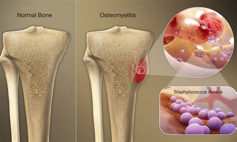 Osteomyelitis Bone Infection Symptoms Causes And Treatment