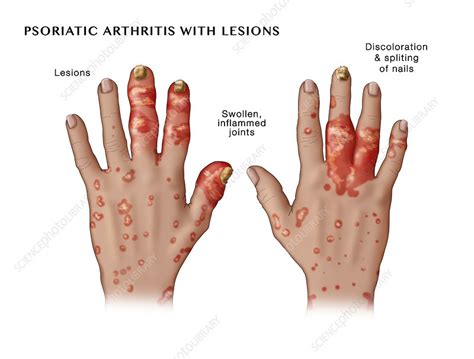 Psoriatic Arthritis With Lesions Stock Image F0319112 Science