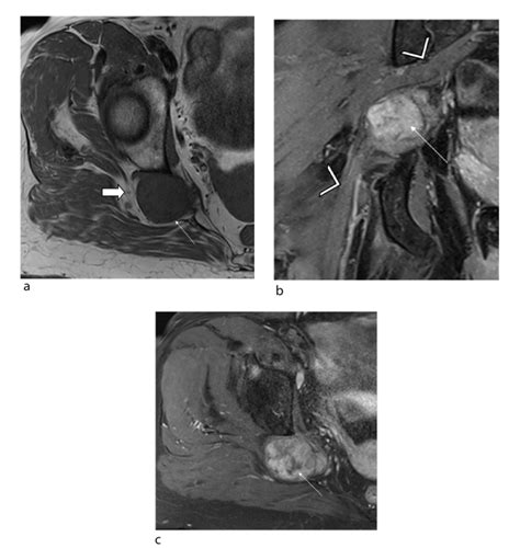 Mri Of Sciatic Nerve Tumours Correlation With Histological Findings
