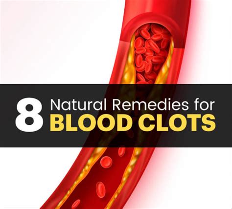 Blood Clots Causes And Symptoms 8 Natural Remedies