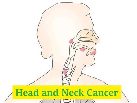 5 Head And Neck Cancer Types And Causes 2022