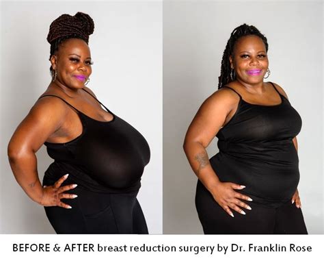 Dr Rose Says It May Be The Largest Breast Reduction Procedure In Career