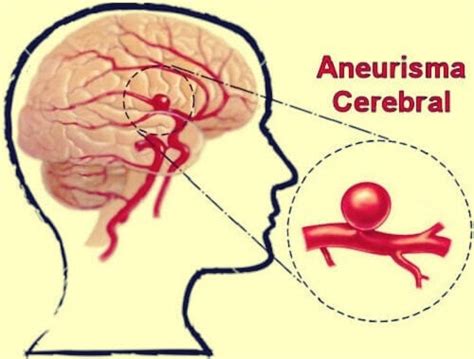 Aneurisma Cerebral Definici N S Ntomas Y Tratamientos