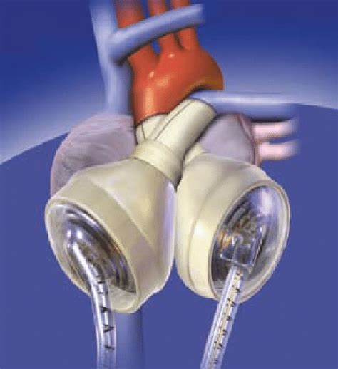 Syncardia Implantation Courtesy Syncardia Systems Inc Download