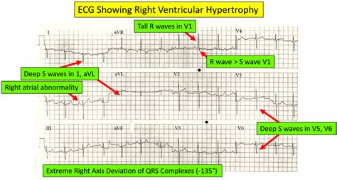 Identifying Right Ventricular Hypertrophy On An Ecg