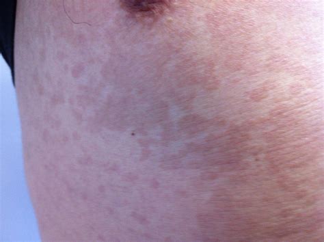 Micose Superficial De Pele Como Evitar As Recidivas Dermatolux