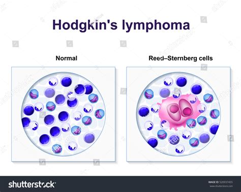 Multinucleate, giant cells found in individuals with hodgkin lymphoma. Hodgkins Lymphoma Biopsy Healthy Human Cells Stock ...