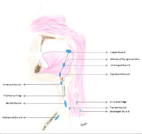 Diagrammatic Representation Of The Different Positions Of The Ectopic