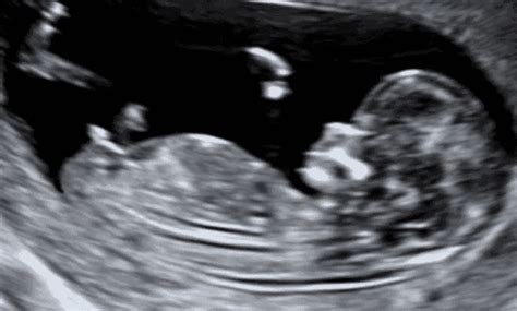 Baby Scan Ultrasound Partners Groupon