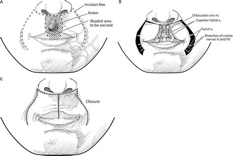 The Karapandzic Flap Operative Techniques In Otolaryngology Head And