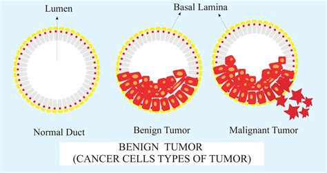 Benign Tumor Pictures