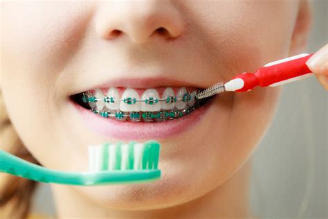 Take Care Of Your Teeth While Wearing Braces David S Mcguire Dds