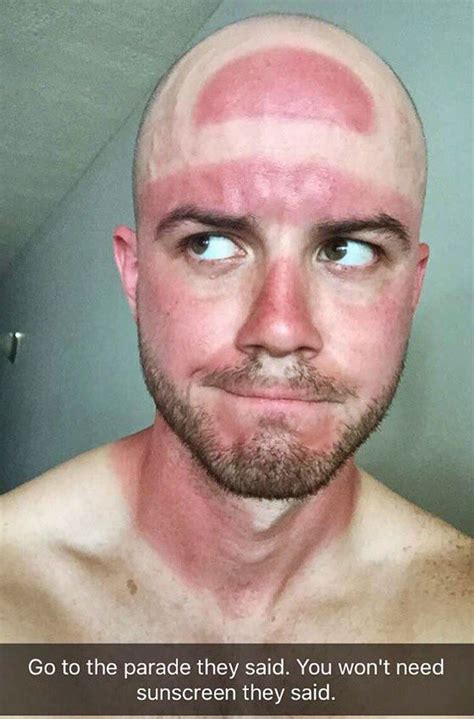 Who Needs A Farmers Tan When You Can Get A Cavs Finals Hat Burn Bad
