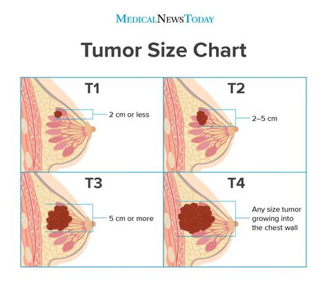 What is ductal carcinoma in situ? How does tumor size relate to breast cancer stage ...