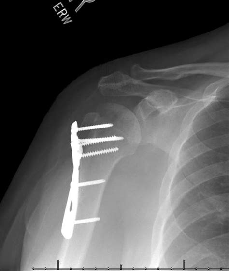 Shoulder And Elbow Surgery Locked Proximal Humerus Fracture Dislocation