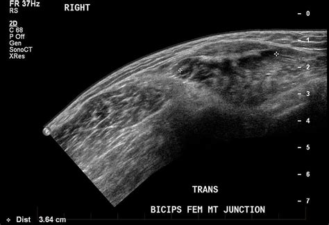 Hamstring Tear Ultrasound Imaging Melbourne Radiology
