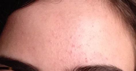 Small Bumps On My Forehead General Acne Discussion By Aaaaaabbb