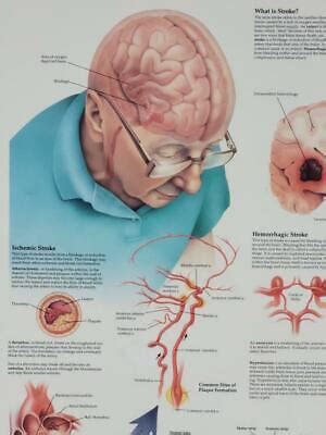 Vintage Laminated Medical Poster Understanding Stroke Anatomical Chart