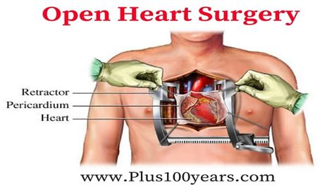 how does open heart surgery work