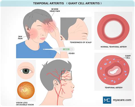 What Is Giant Cell Arteritis Mya Care