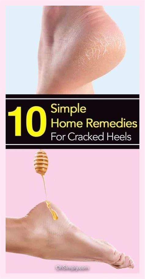 20 Home Remedies For Cracked Heels Causes Prevention Tips Artofit