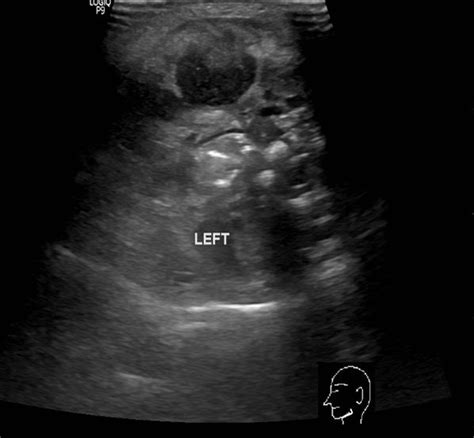 Neck Abscess Ultrasound