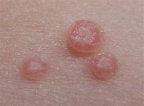 Molluscum Contagiosum And Find Out More About This Growing Viral Skin Co