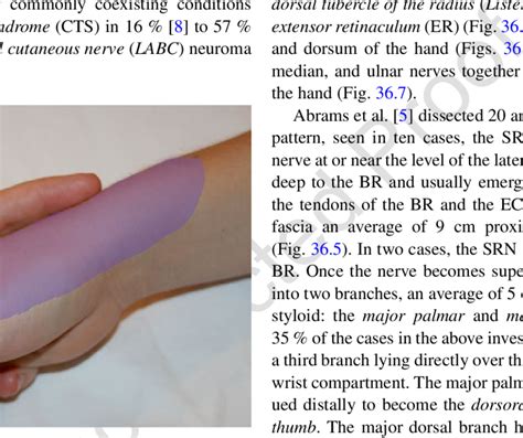 2 Pain Pattern Associated With Superficial Radial Nerve Entrapment