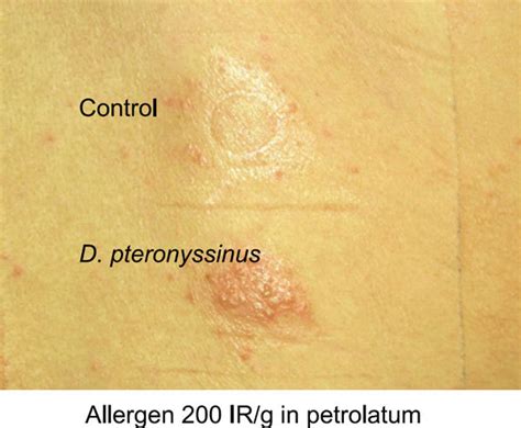 The Apt With House Dust Mite D Pteronyssinus In A Patient With Ae