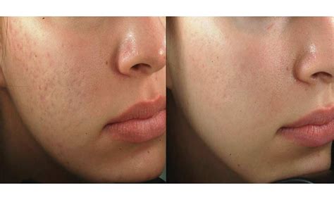 How To Get Rid Of Deep Acne Scars Overnight 2023 Easy Method