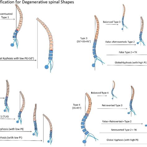 Classification Of The Degenerative Spinal Sagittal Alignment According