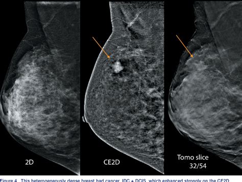 Figure 4 From The Principles Of Contrast Mammography Semantic Scholar