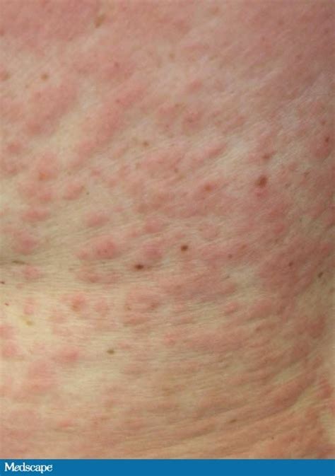 Liver Disease Rash Pictures Photos