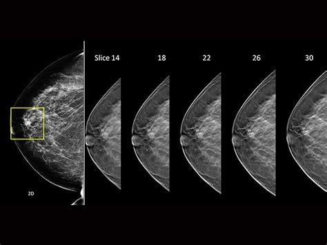 Breast Tomosynthesis Outperforms Standard Mammography