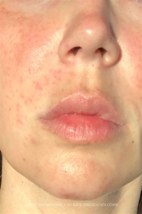 Are You Suffering From Maskne During Covid 19 Pure Dermatology
