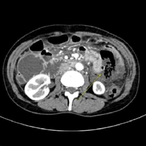 Ct Scan Of The Abdomen Revealed Abdominal Fluid Collection With Air
