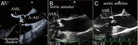 Aortic Valve Replacement For Calcified Aortic Valves Intechopen