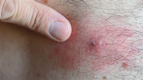 Rash 22 Common Skin Rashes Pictures Causes And Treatment