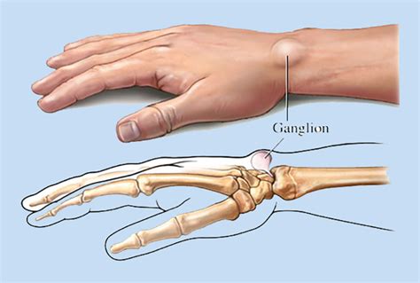 Gangalion Cysts Symptoms And Treatment South Florida Hand Center
