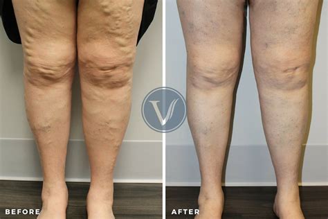 Leg Pain And Swelling Treatment The Vein Institute At Ssa