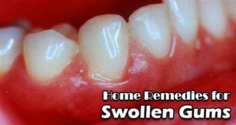 14 Home Remedies For Swollen Gums