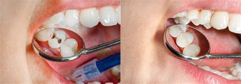 Average Cost Of Tooth Filling How Much Tooth Filing Cost In Los Angeles