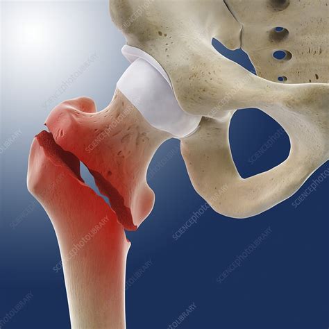 Fractured Hip Artwork Stock Image C0148415 Science Photo Library
