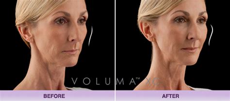 Miami Center For Cosmetic Dermatology Dr Deborah Longwill Voluma Longwill Miami Dermatology