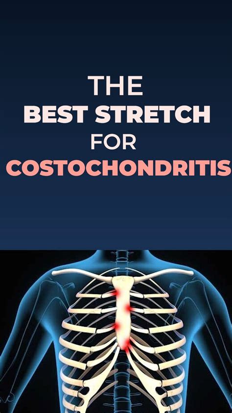 Costochondritis Stretches Short My Favorite All Time Costochondritis